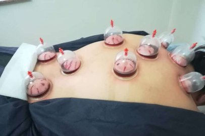 GELENEKSEL TEDAVİ YÖNTEMLERİNE BÜYÜK İLGİ