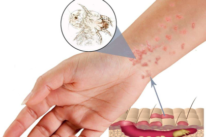 Korkutan salgın! Uyuz vakaları artıyor