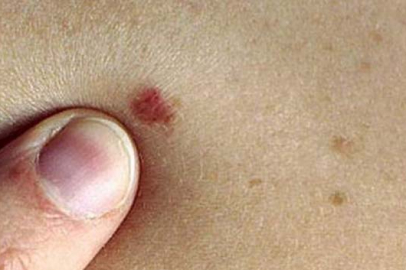 Yalova İl Sağlık Müdürlüğü cilt kanserine dikkat çekti