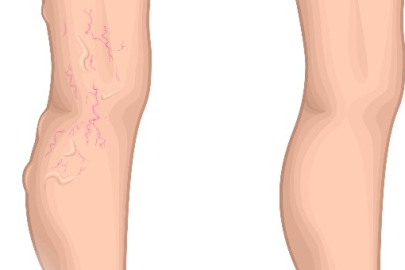 Varis oluşumunu önlemek için bunlara dikkat edin